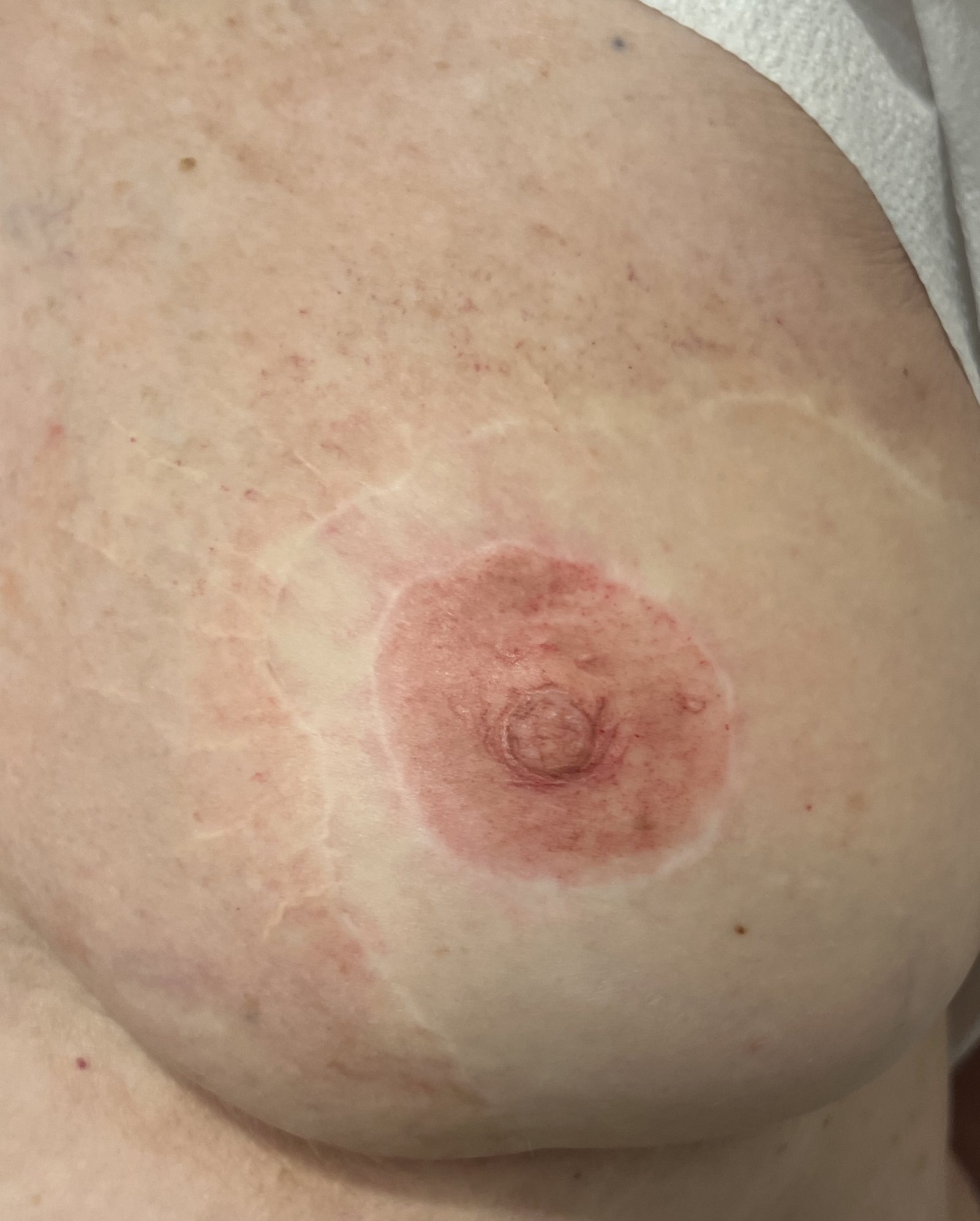 Close view of a healed areola restoration showing the graduated edge where pigment meets skin.