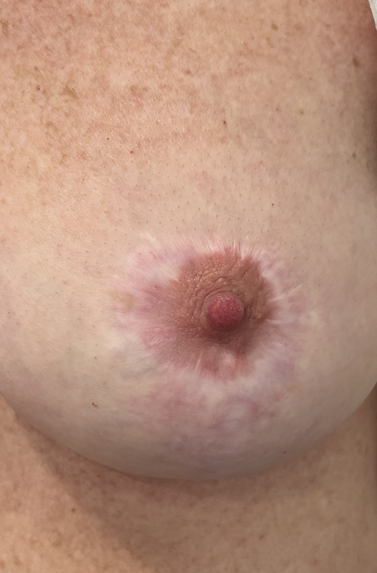 Healed unilateral areola restoration, the rebuilt areola matched in tone to the opposite side.