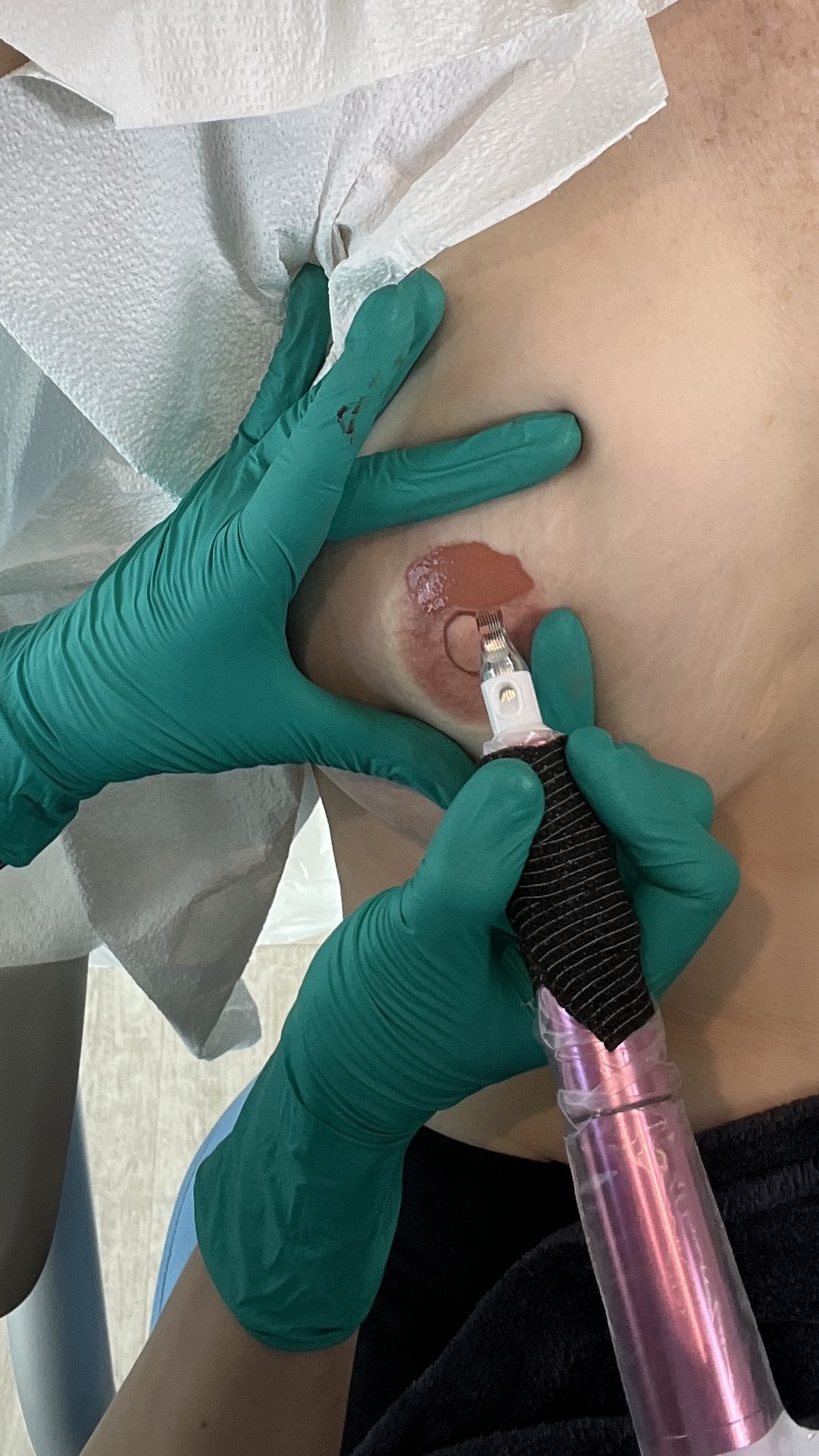 Ella's gloved hands shading a new areola with the pigment machine, the skin draped with paper.