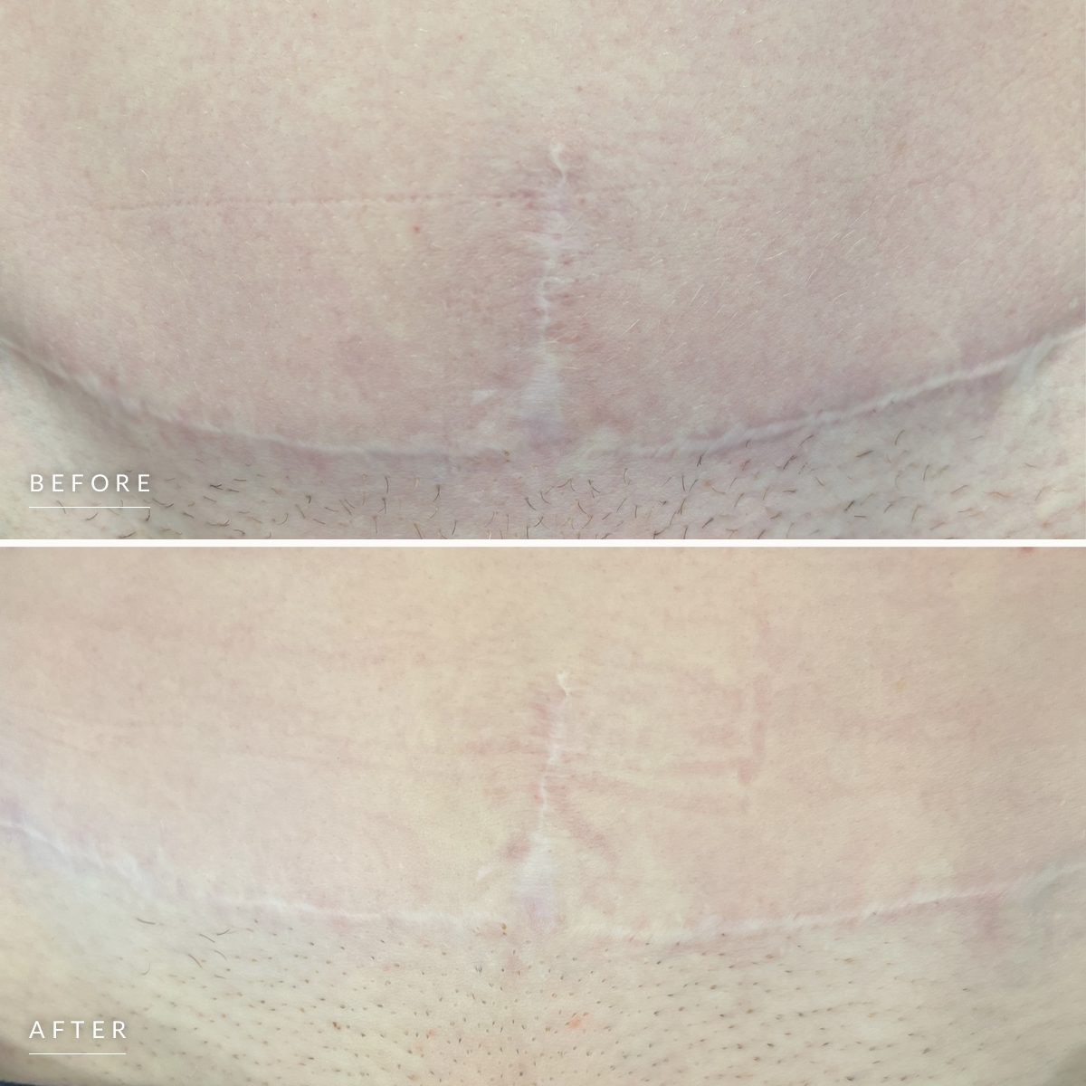 Microneedling before and after, stacked: a raised, pale tummy tuck scar, then the same scar looking softer and closer to the skin around it, healed.