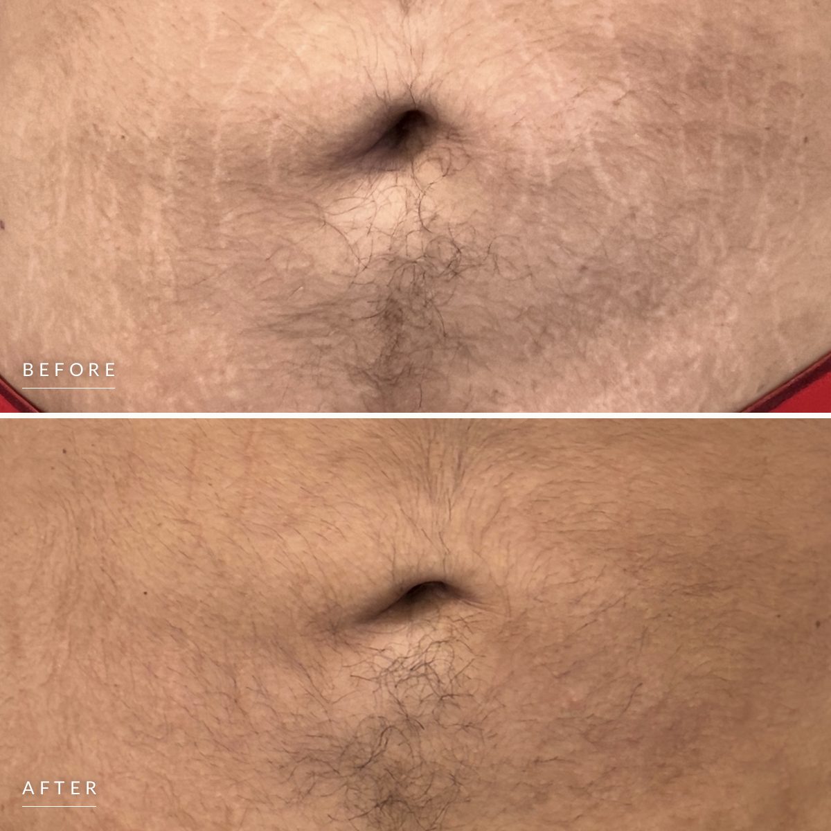 Stretch mark camouflage before and after, stacked: pale stretch marks around the navel, then the marks filled in close to the skin tone, healed.