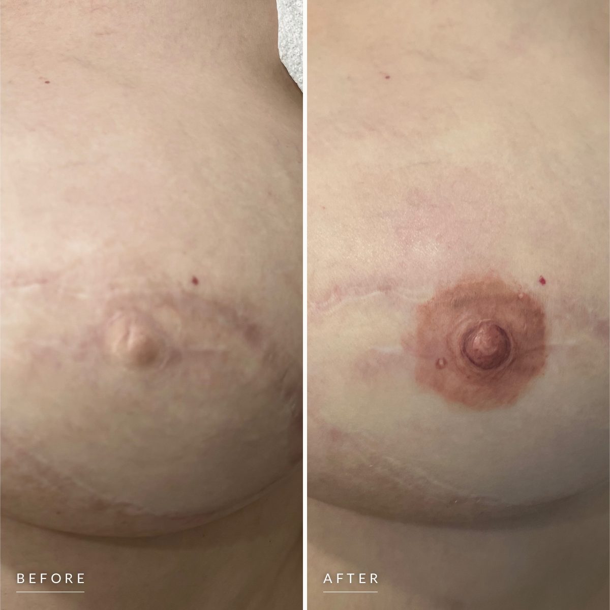 Before and after areola restoration: a reconstructed breast with a pale nipple and no areola, then the same breast with a rose-brown 3-D areola tattooed around it.