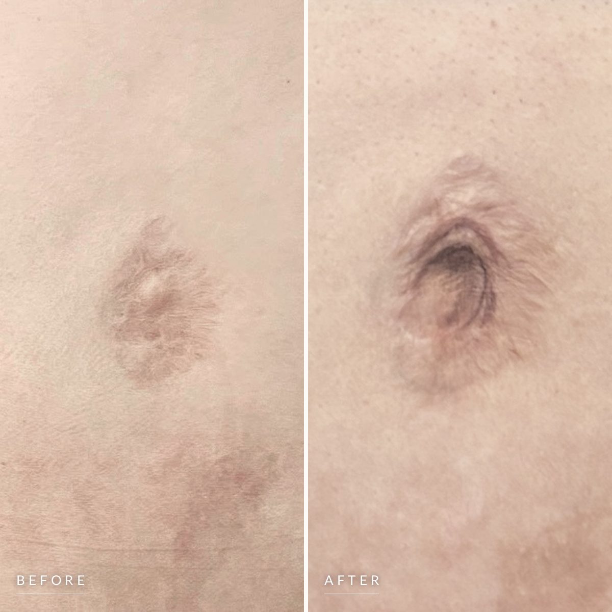 Belly button restoration before and after, side by side: a flat, faint navel scar, then a belly button shaded by hand so it reads as a deep, natural recess.