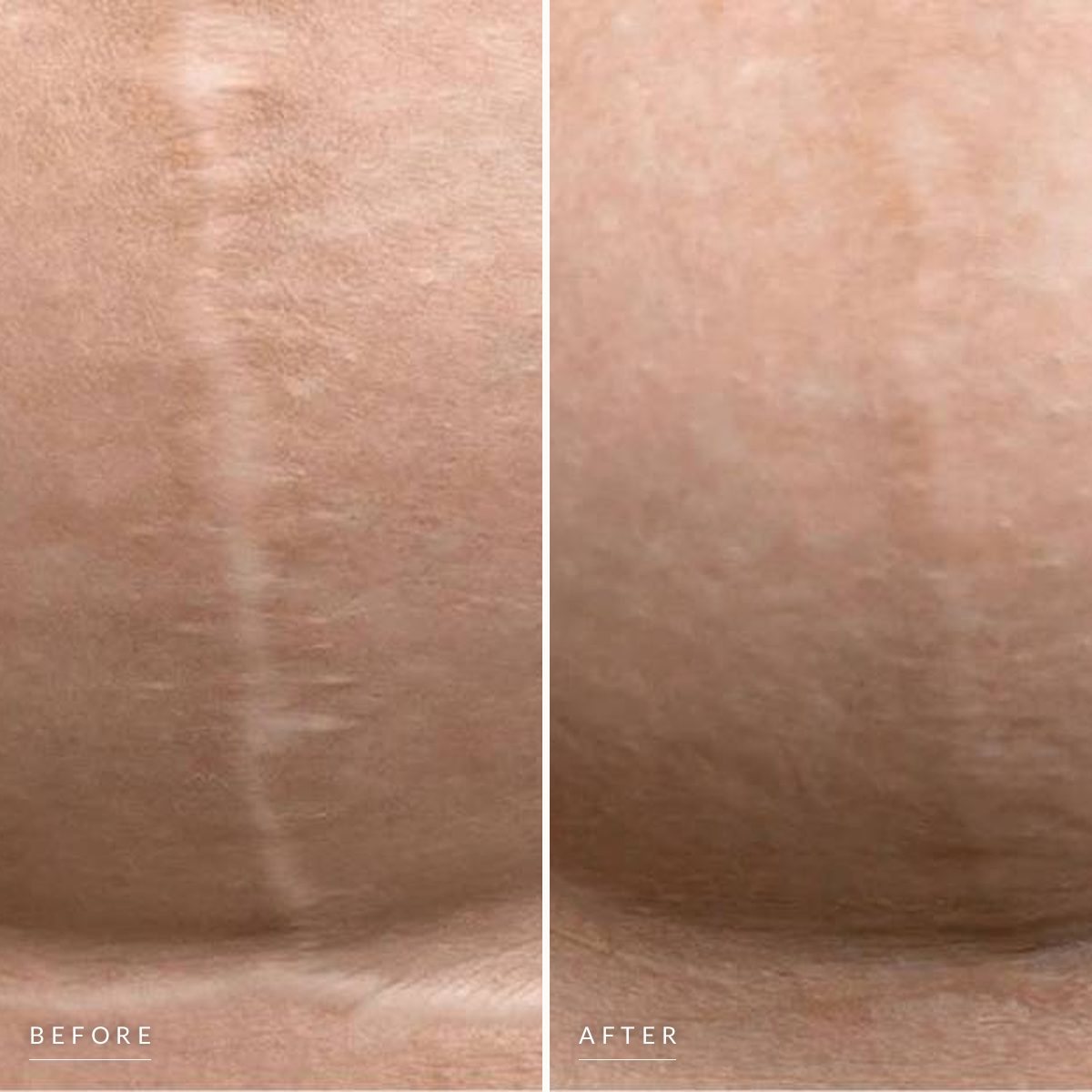 Scar camouflage before and after, side by side: a pale vertical scar across the abdomen, then the same area with the scar blended into the skin tone.
