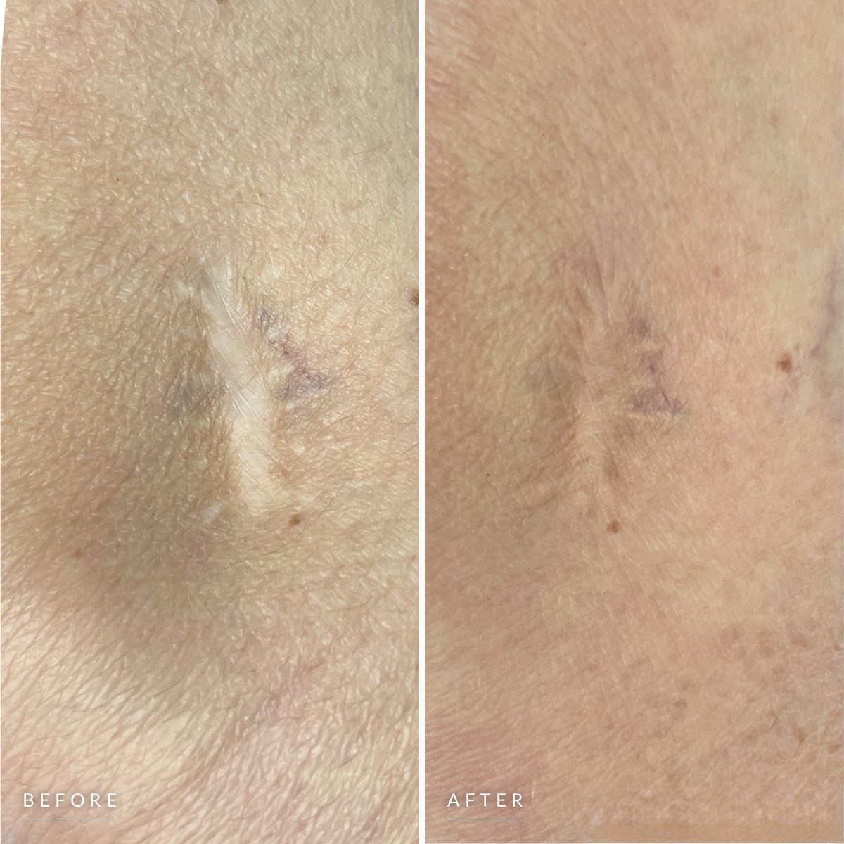 Before and after scar camouflage: a pale, raised white scar, then the same scar toned to match the surrounding skin.