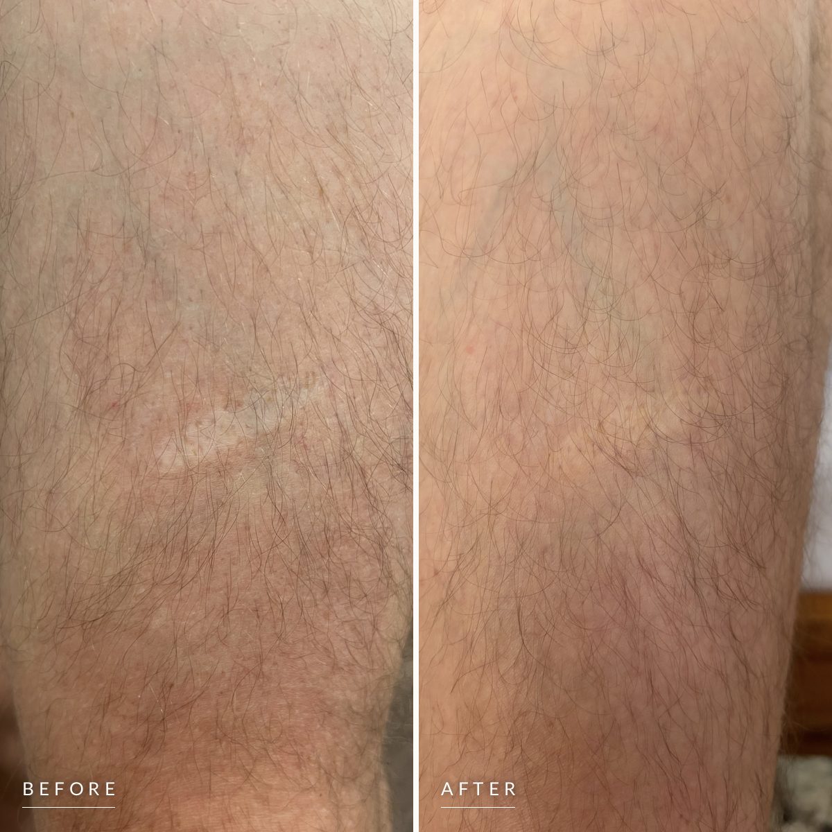 Before and after scar camouflage on a leg: a pale scar across the shin, then the same area with the scar blended into the skin around it.