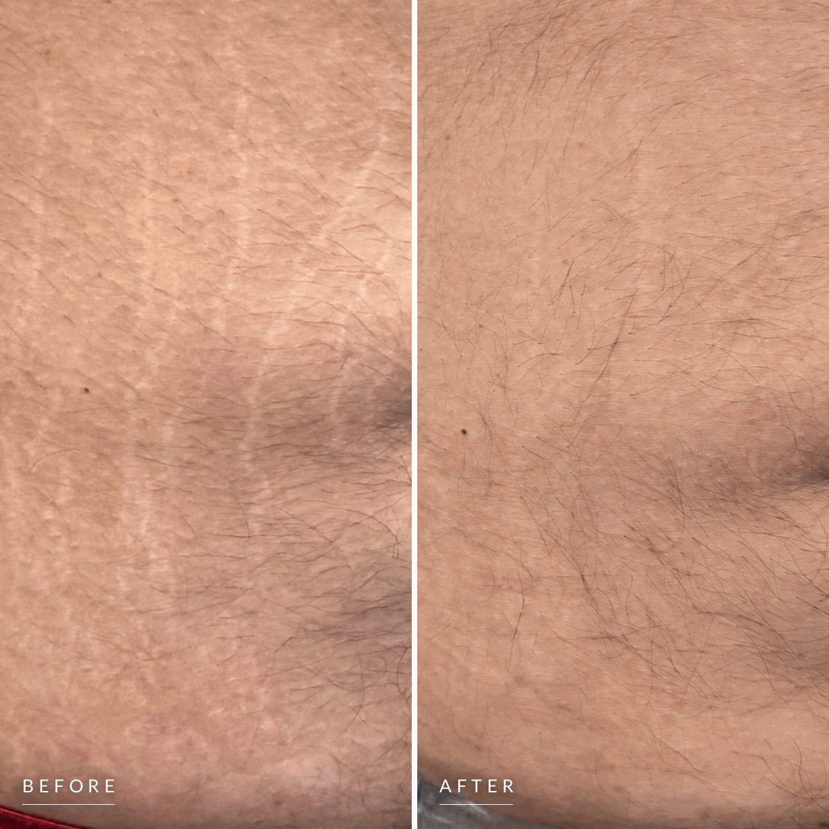 Before and after stretch mark camouflage on an abdomen: pale silvery stretch marks, then the same skin with the marks blended into the surrounding tone.